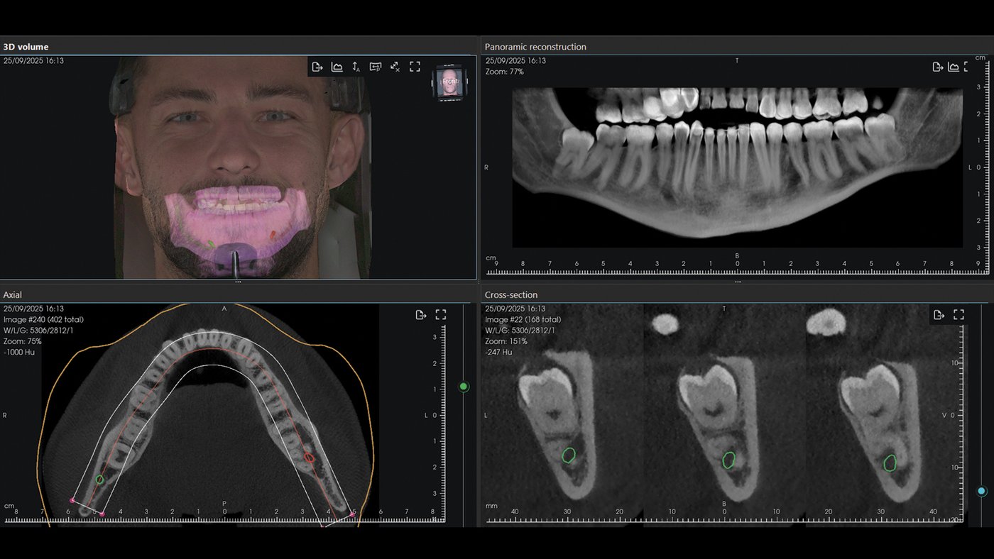 Reconstruction 3D CBCT Hyperion X9 Pro